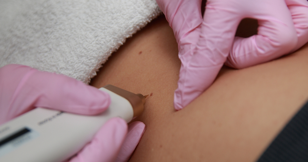 Mole And Tag Removal Treatments