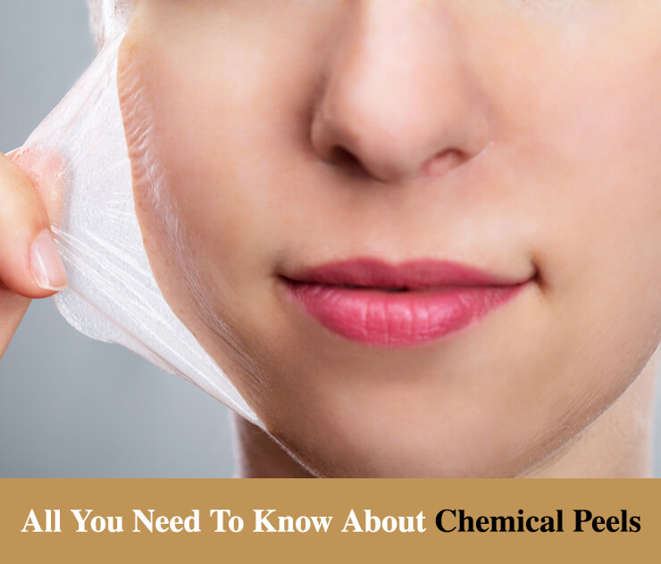 All you need to know about Chemical peels